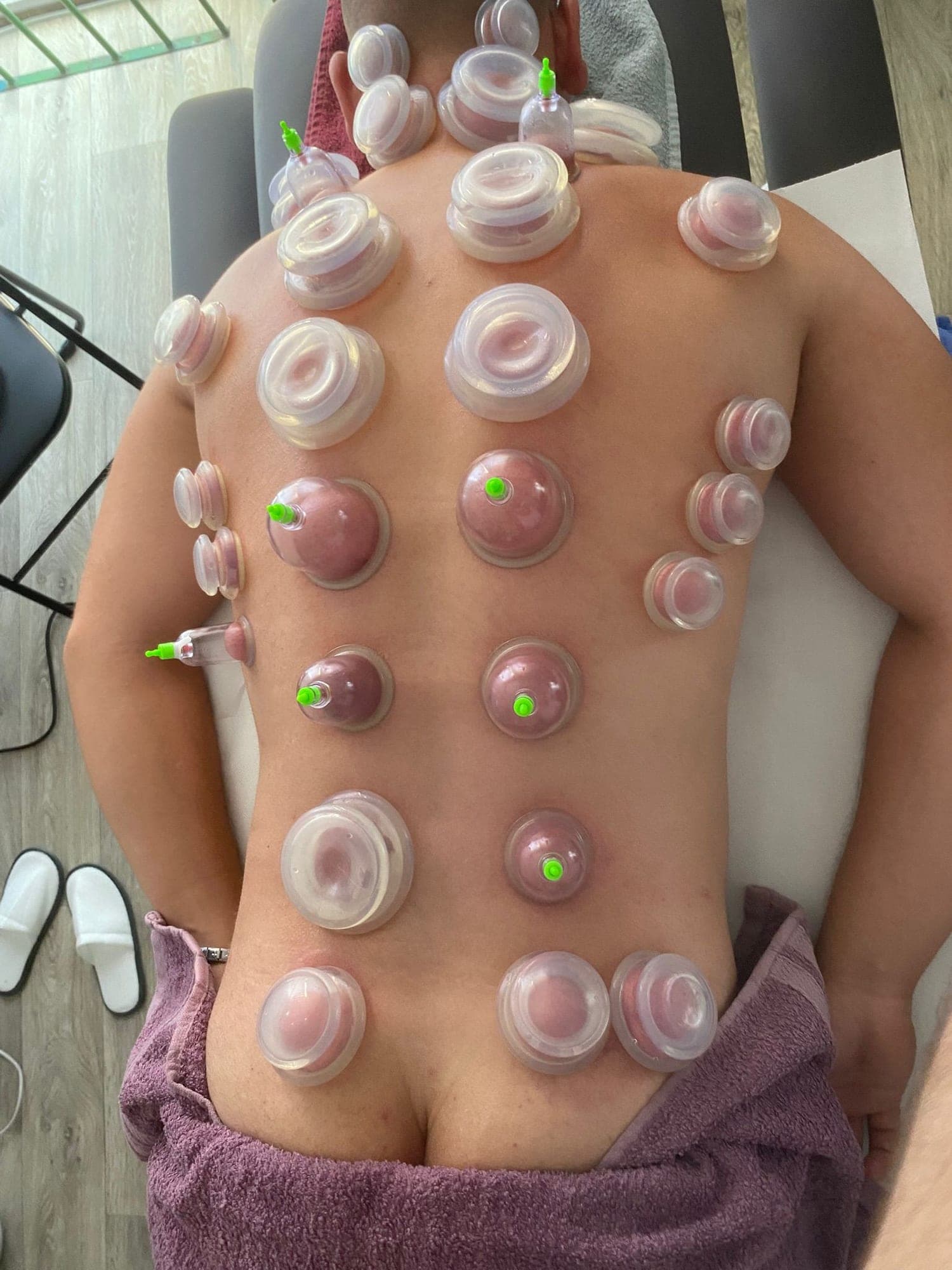 Cupping terapija u Fiziosensu — vakuum čašice postavljene na leđima pacijenta (Leskovac)